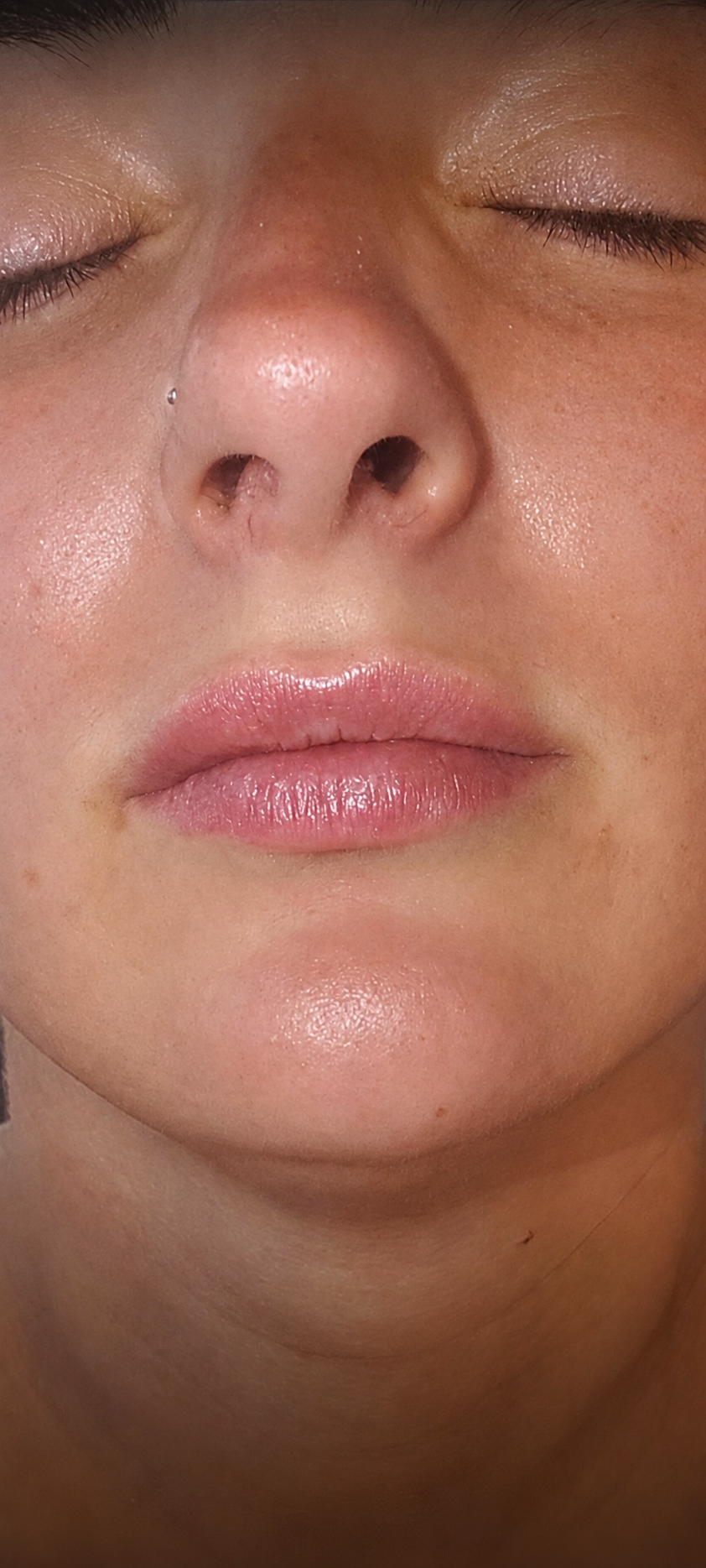 After lip filler treatment