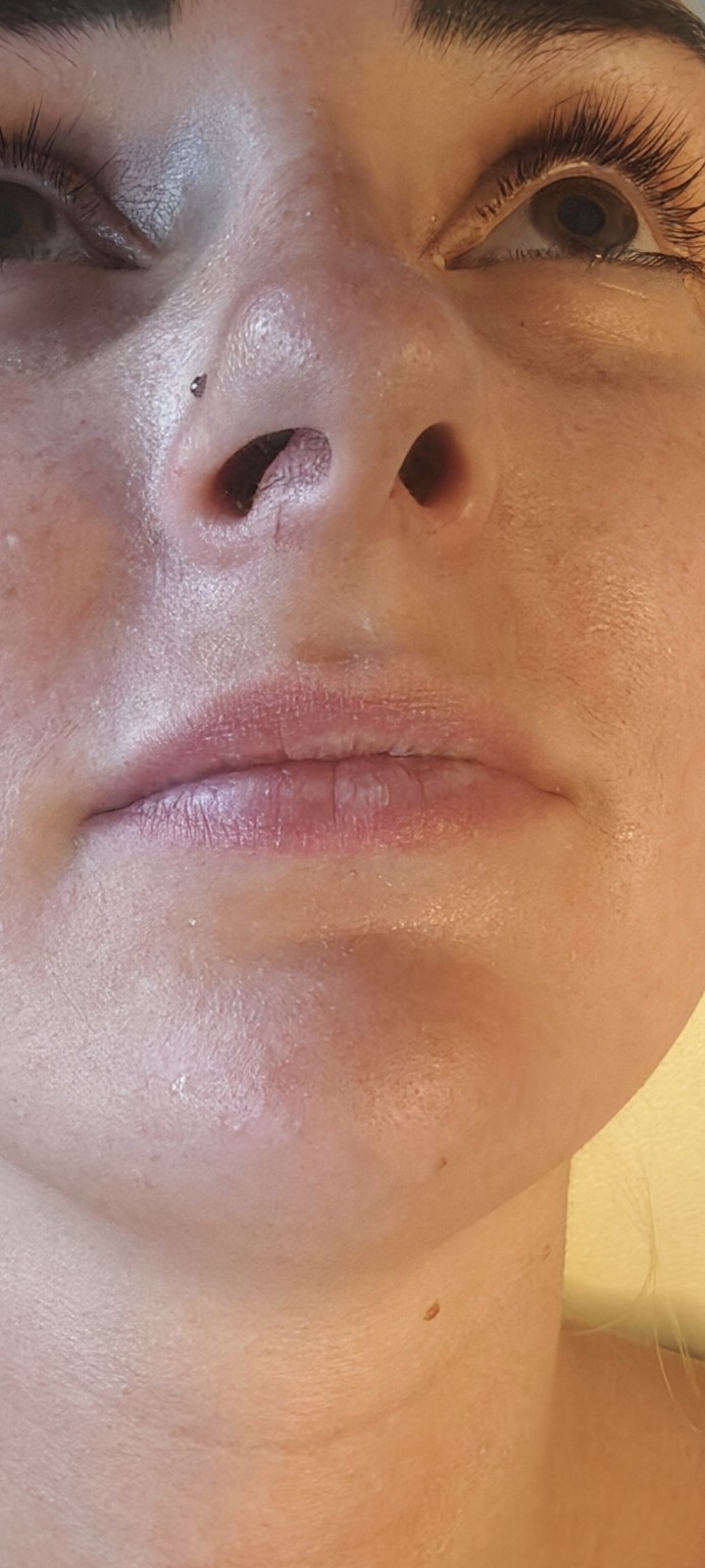 Before lip filler treatment